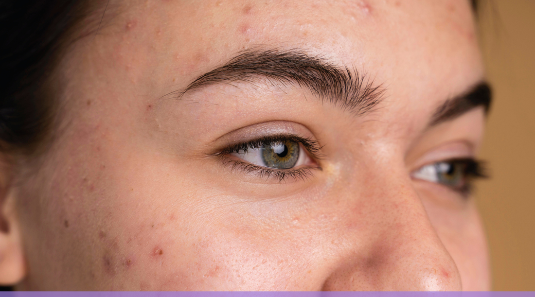 How to Fade Dark Spots: A Gentle Korean Skincare Routine for Hyperpigmentation